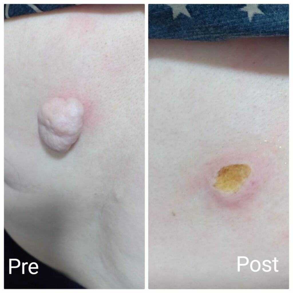 Skin tags removal in Nadara Clinic